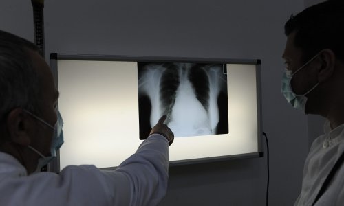 Svjetski dan kronične opstruktivne bolesti pluća: Trenutno je najveći uzrok pušenje, a uskoro će biti zagađenje