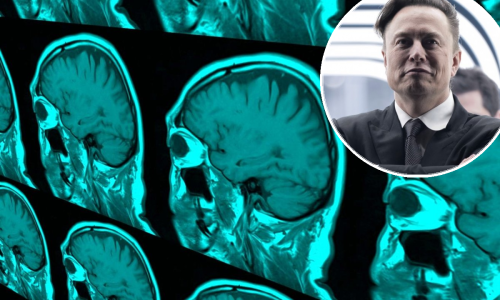 [VIDEO] Musk tvrdi da će moždani čip testirati na ljudima već za šest mjeseci, prvi će ga javno isprobati