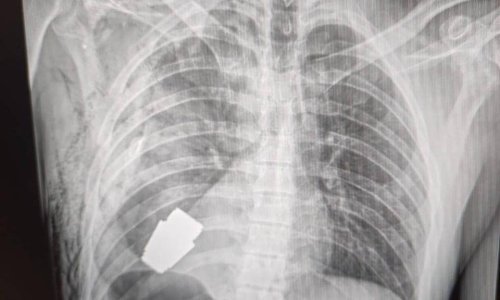 Kirurzi uklonili neeksplodiranu granatu zaglavljenu u prsima ukrajinskog vojnika