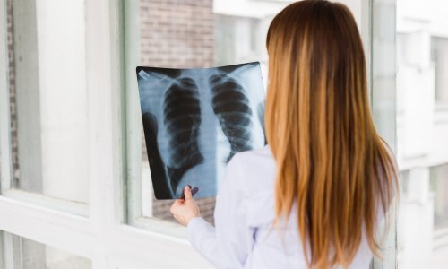 Hrvatski program ranog otkrivanja raka pluća proglašen najboljim u svijetu: 'U dvije godine odaziv je 95 posto'