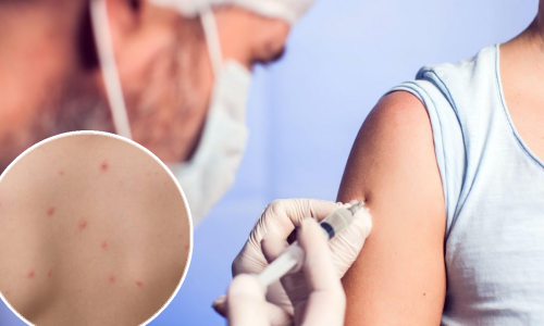 Prijeti li Srbiji epidemija ospica? Zaraza bukti, prijavljeni novi slučajevi u Beogradu, Smederevu, Novom Sadu...