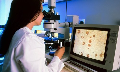 Prvi znakovi Alzheimerove bolesti mogu se pojaviti u očima