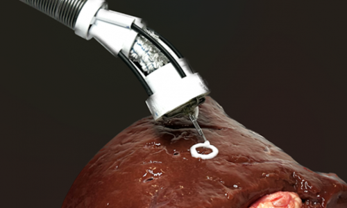 Australski inženjeri razvili 'fleksibilnog robota' za 3D printanje unutar tijela