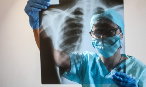 Rijetka gljivična infekcija u SAD-u uzela prvu žrtvu među oboljelima u tvornici papira