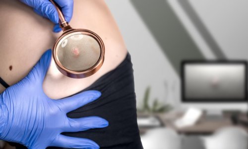 Stižu sve sunčaniji dani, a s njima i opasnost od zloćudne bolesti