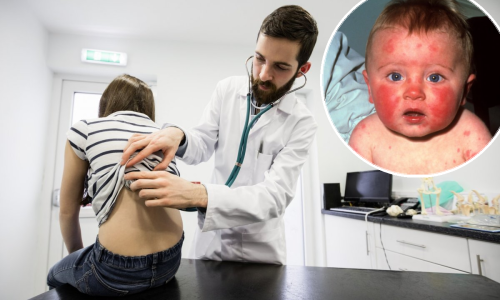 Ponovno se pojavila 'peta bolest'; nema razloga za paniku, ali ovo trebate znati