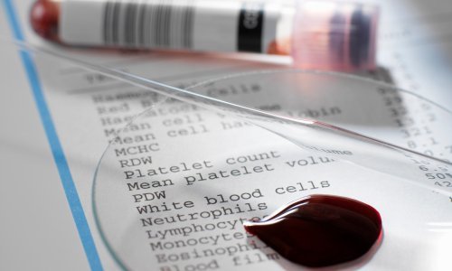 Dok ostali napreduju u liječenju raka krvi, kod nas od 2019. nema nove terapije