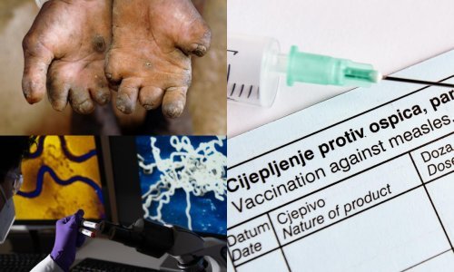 Sifilis, guba, giht: Vraćaju se bolesti od prije 100 i više godina, evo gdje je najgore