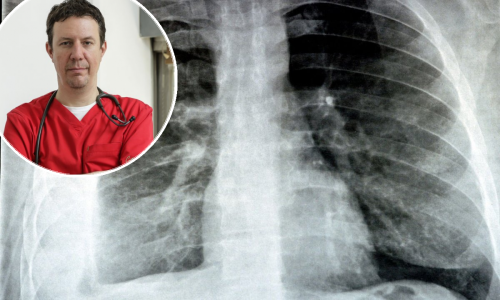 Kako prepoznati tzv. hodajuću upalu pluća i kada se javiti liječniku