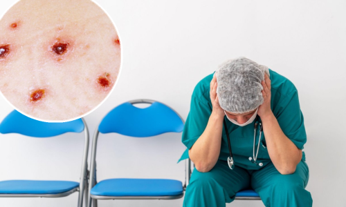 Majmunske boginje stigle u Europu: Prvi slučaj izvan Afrike zabilježen u Švedskoj