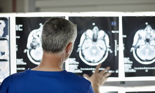 Dokaza je puno: Covid ostavlja posljedice na mozak, ovo su najčešći simptomi