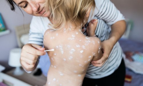 Dječak postao teški invalid nakon vodenih kozica: 'Antivakseri, ovo morate vidjeti'