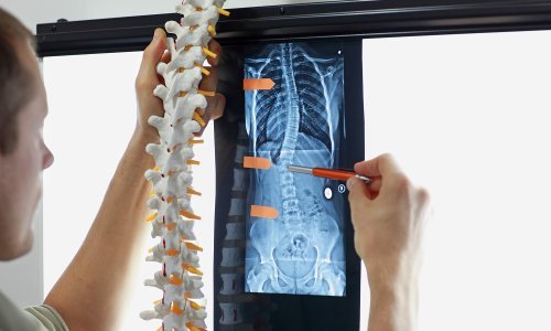 Zdravlje kralježnice i nove terapije u liječenju skolioze