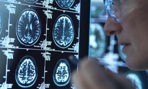 Oko 80 tisuća Hrvata živi s posljedicama moždanog udara