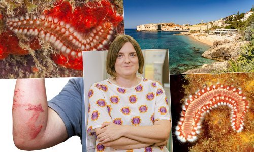Opasnost u Jadranu: Vatreni crvi nanose bolne ozljede - stručnjaci savjetuju kako ih izbjeći i sanirati