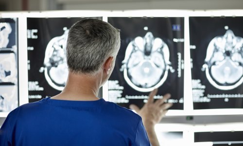 Pacijentici u KB Dubrava ugradili printani komad lubanje: Više se ne vidi defekt