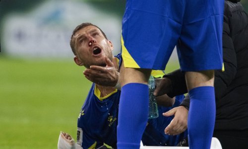 Edin Džeko objavio kako mu izgleda lice nakon brutalnog udarca kopačkom u glavu