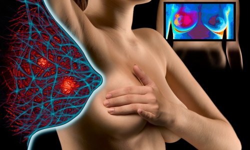 Umjetna inteligencija pomaže u ranijem otkrivanju agresivnih karcinoma dojke