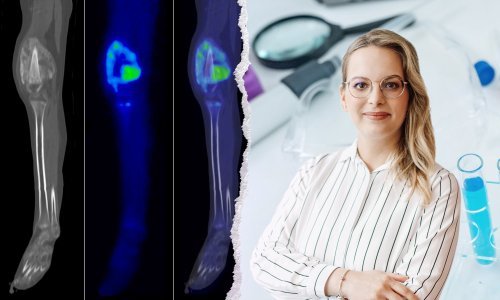 Mlada hrvatska znanstvenica istražuje mikrosfere koje napadaju rak kostiju, a štede zdravo tkivo