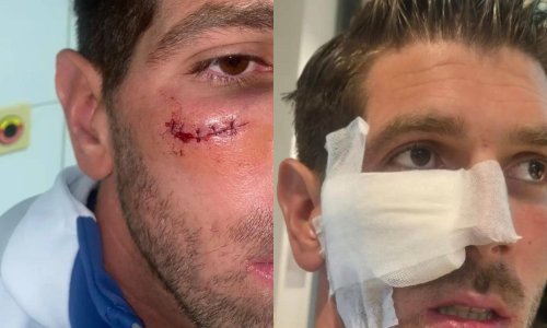 Slaven Belupo objavio fotografije ozljede njihovog stopera: Ako ovo nije za crveni...