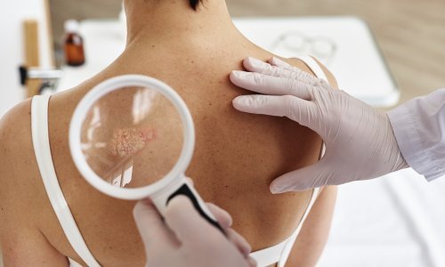 Otkriven skriveni okidač karcinoma: Virus se stopio s DNK-om i potaknuo agresivan rak kože