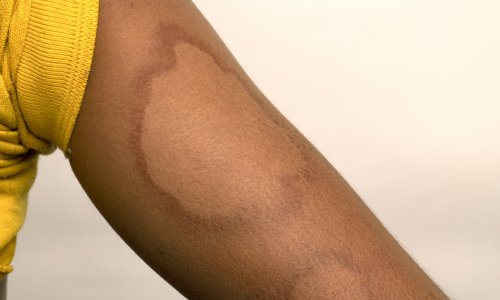 Udruga pacijenata ogorčena šutnjom o slučaju gube: Ovako nešto ne smije se zataškavati