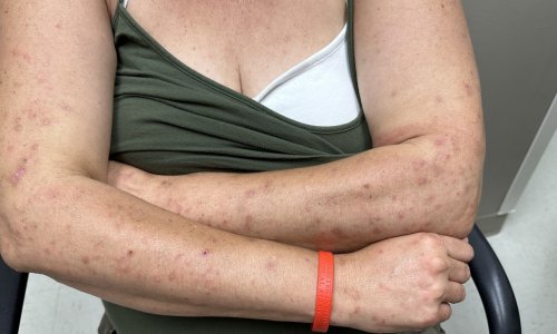 Srbi u panici: Šuga se širi zemljom, zaraza kola školama, vrtićima i tvornicama