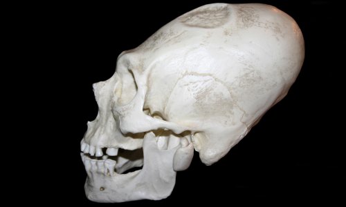 Izduživanje lubanja: Što se krije iza jednog od najbizarnijih običaja u povijesti?