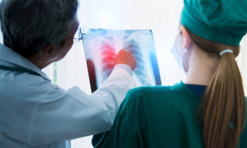 Golem proboj u liječenju raka pluća: 'Nikad nismo bili bliže rješenju'