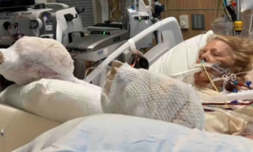 Žena zaspala na bazenu za vrijeme sunčanja: Zatajili joj organi, opečena je do kosti