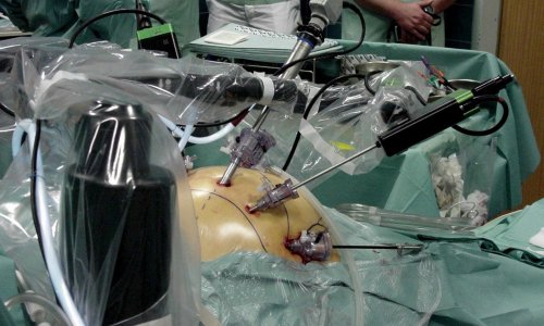 AI pomogao kirurzima ukloniti tumor na mozgu