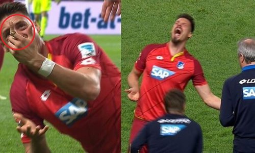 Hoffenheimov napadač vrištao je dok su mu namještali prst