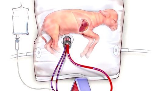 Ova umjetna maternica mogla bi spašavati živote nedonoščadi