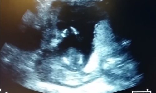 Čudo od fetusa - već zna koreografiju popularne dječje pjesme