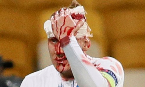 Krvava ozljeda Domagoja Vide šokirala gledatelje u Kijevu!