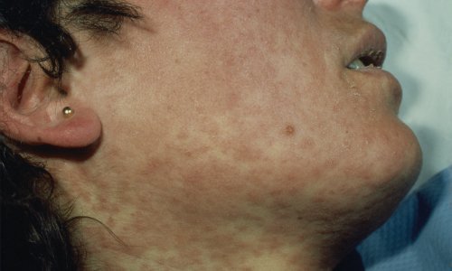 Epidemija ospica se ne smiruje, u Srbiji više od 2.000 oboljelih