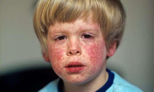 Necijepljenoj djeci u Dubrovniku zabranjen dolazak u vrtiće zbog epidemije ospica