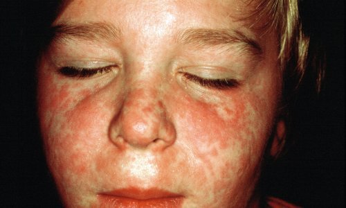 Epidemiologinja upozorava: Ospicama je potrebno tek 15 minuta da se prošire