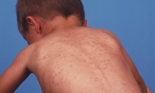 U Srbiji sedma žrtva ospica, preminula medicinska djelatnica