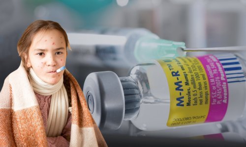 Rekordan broj slučajeva ospica u Europi, djelomično zbog odbijanja cijepljenja