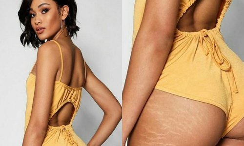 Strije u prvom planu: Konačno realna slika koja prikazuje žensko tijelo onakvo kakvo ono jest