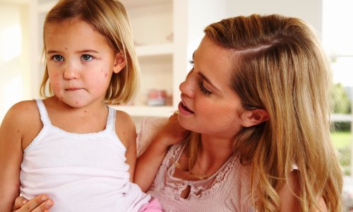 Srbiju trese epidemija ospica, vrtići vraćaju necijepljenu djecu