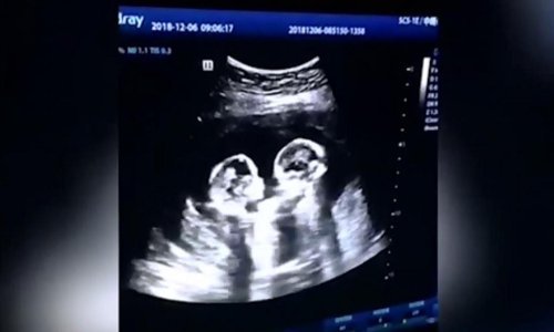 Preludo: Otac tvrdi da je snimio blizanke kako se tuku u majčinoj utrobi