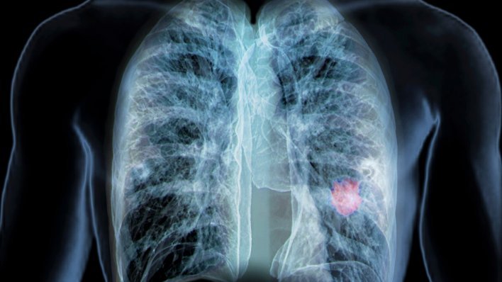 Svijet u šoku: Razvijena tableta koja prepolovljava rizik smrti od raka pluća