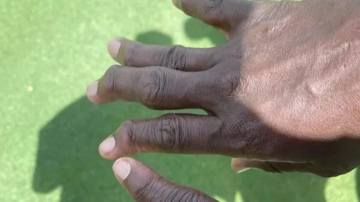 Šokantne posljedice: Ovako izgledaju prsti igrača američkog nogometa