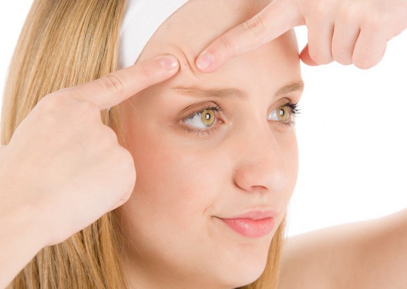 Reagirajte na vrijeme: Evo što otkrivaju akne na vašem licu