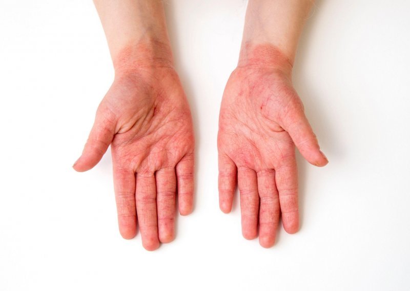 Nisu samo nožni prsti: I crveni osip po tijelu može biti znak dugotrajne upale i zaraze Covidom-19