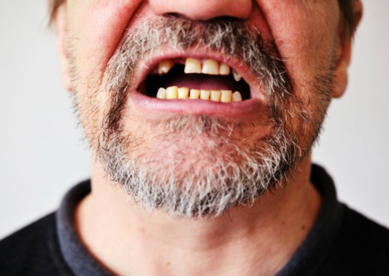 Njemački stomatolozi otkrili kako se može sačuvati izbijeni zub