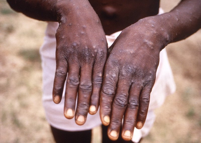 U Sudanu potvrđen prvi slučaj majmunskih boginja