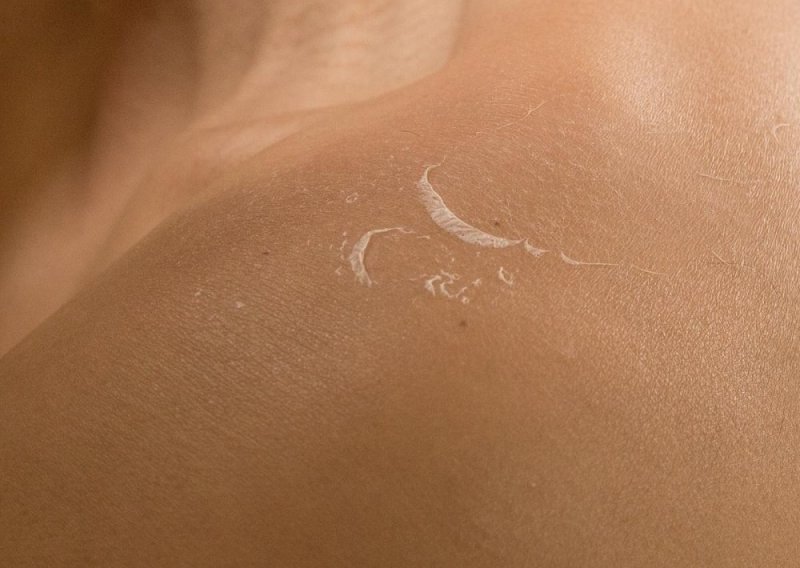 Kako spriječiti guljenje kože nakon ljetovanja? Imamo rješenje
